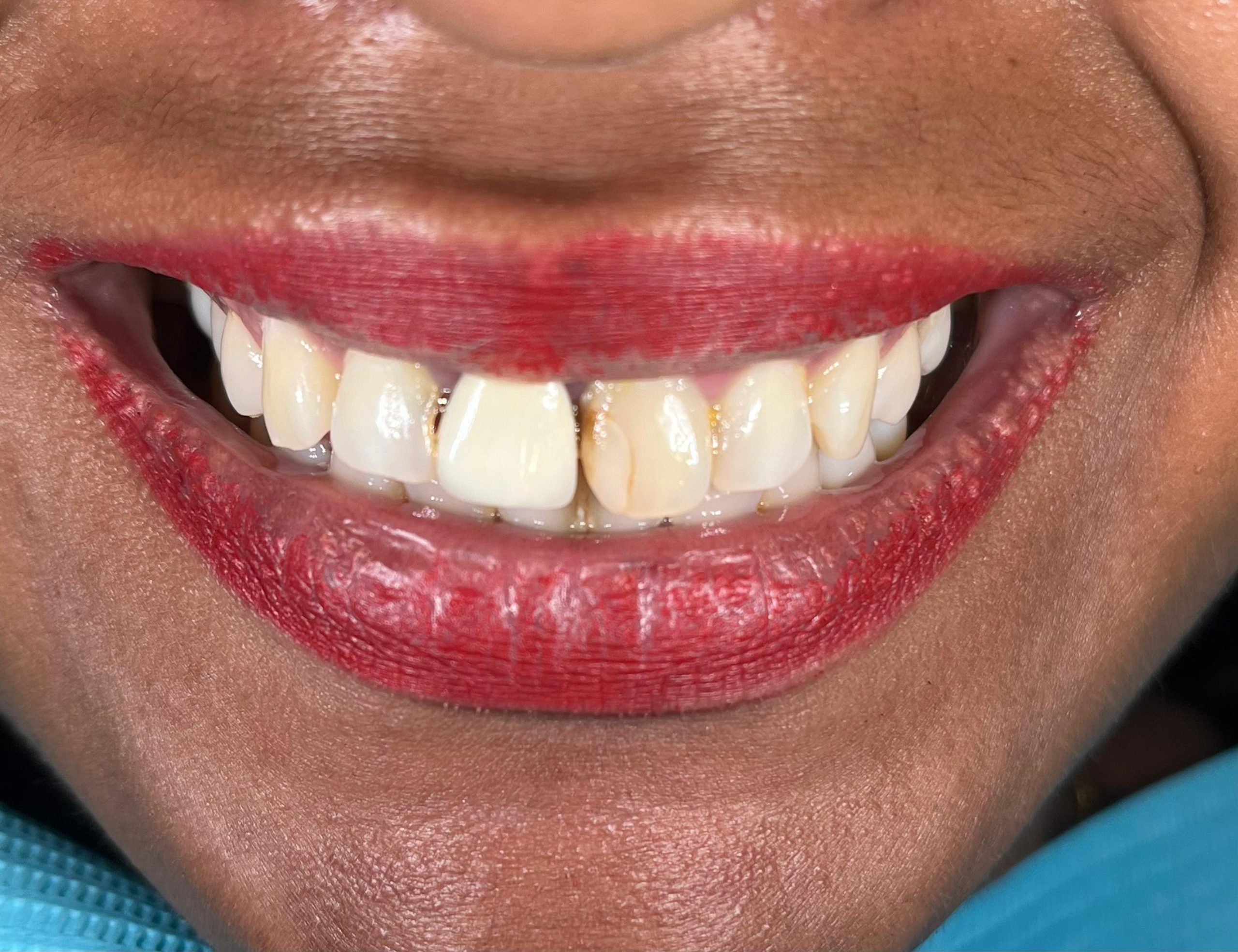 Full mouth rehabilitation with porcelain crowns in Bali