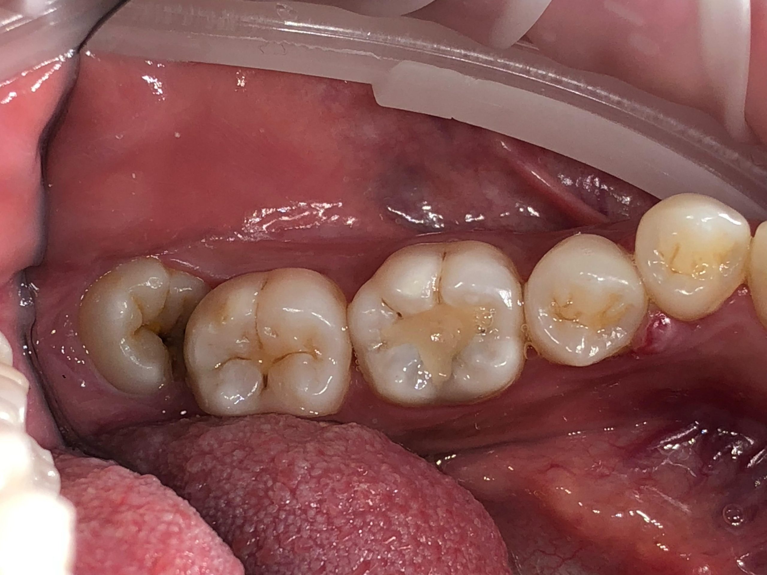Surgical wisdom tooth extraction procedure at Fidelity Dental Bali
