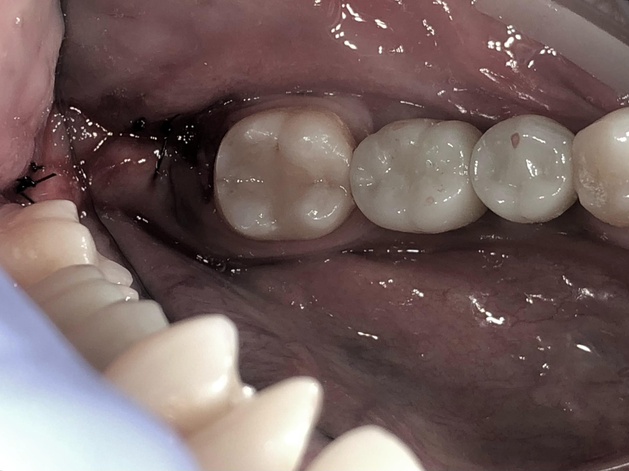 Surgical wisdom tooth extraction procedure at Fidelity Dental Bali