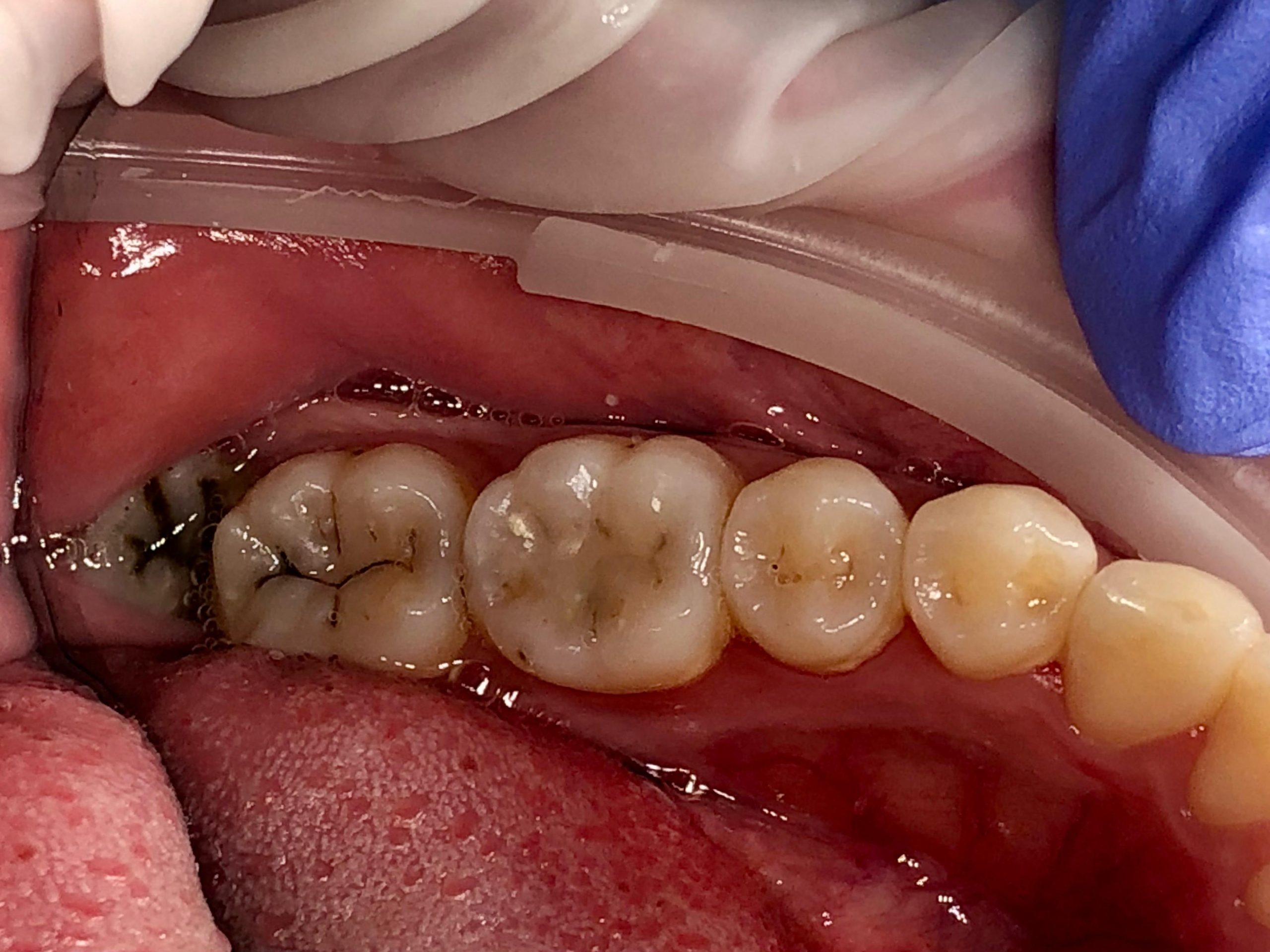 Surgical wisdom tooth extraction procedure at Fidelity Dental Bali