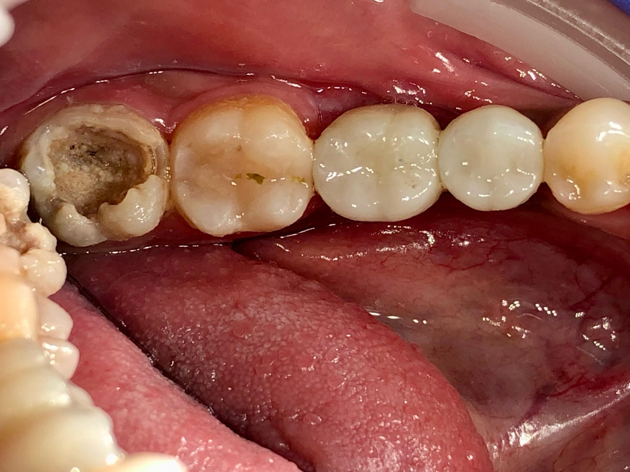 Surgical wisdom tooth extraction procedure at Fidelity Dental Bali