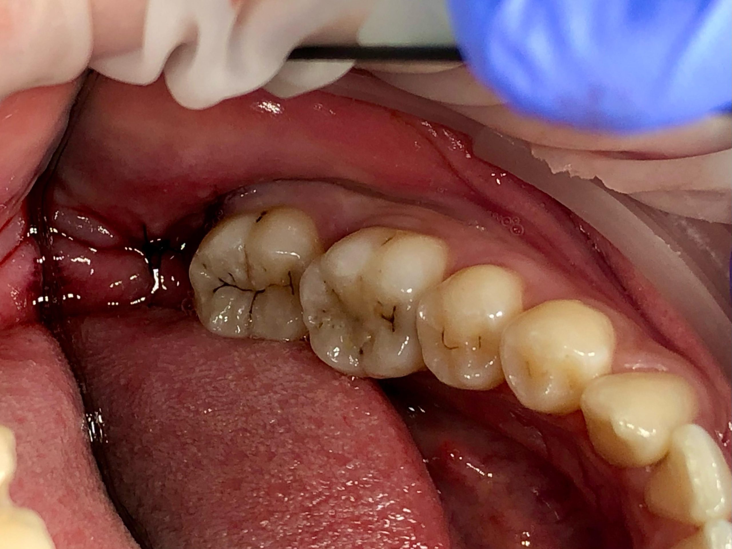 Surgical wisdom tooth extraction procedure at Fidelity Dental Bali