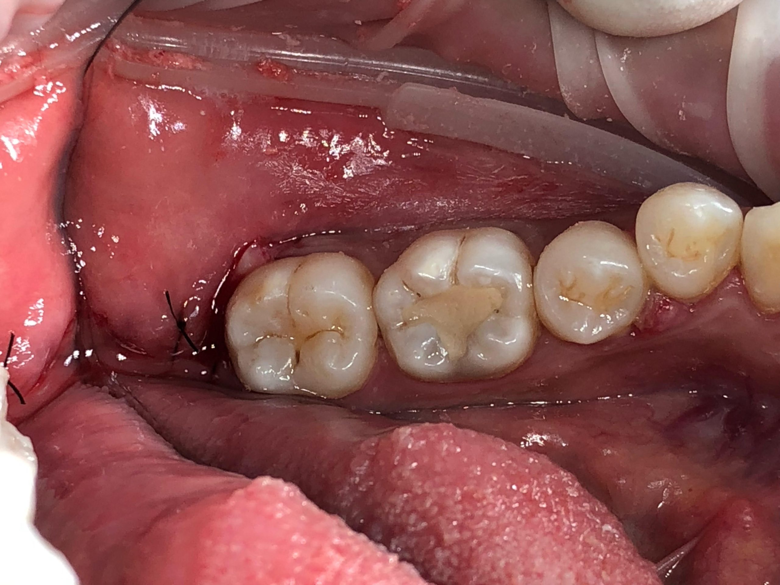 Surgical wisdom tooth extraction at Fidelity Dental Bali