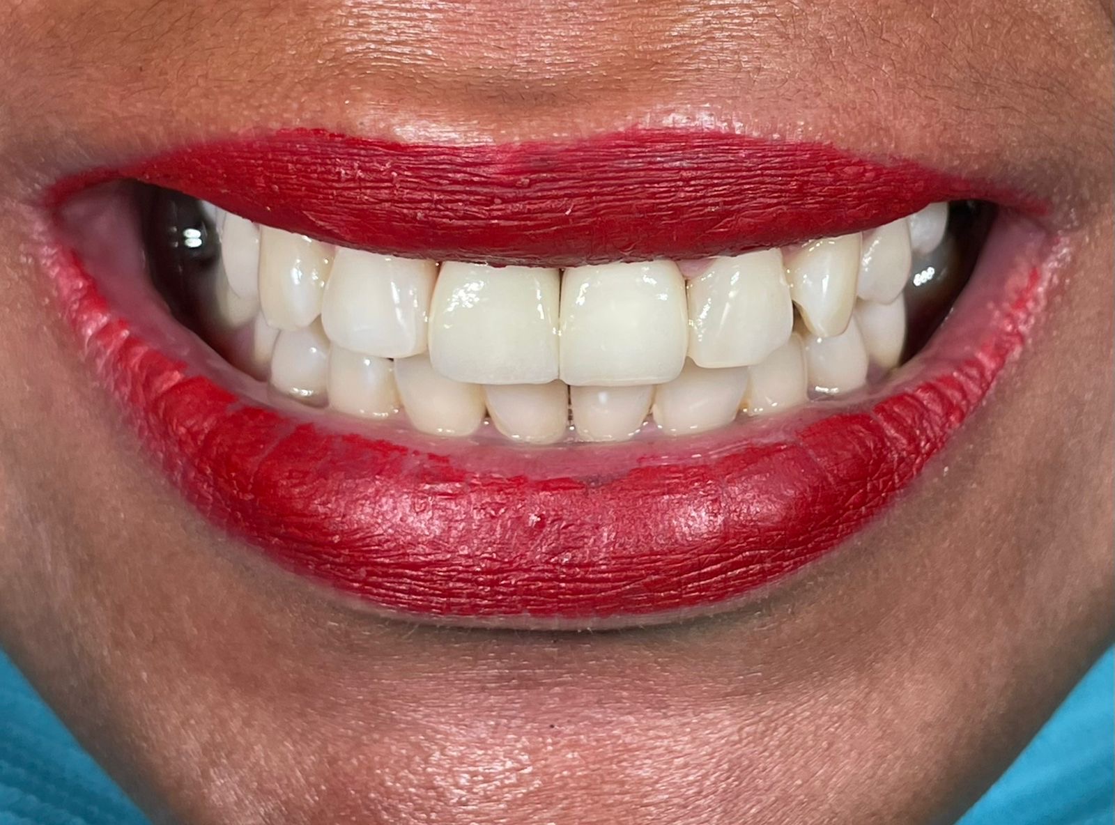 Full mouth rehabilitation with porcelain crowns in Bali
