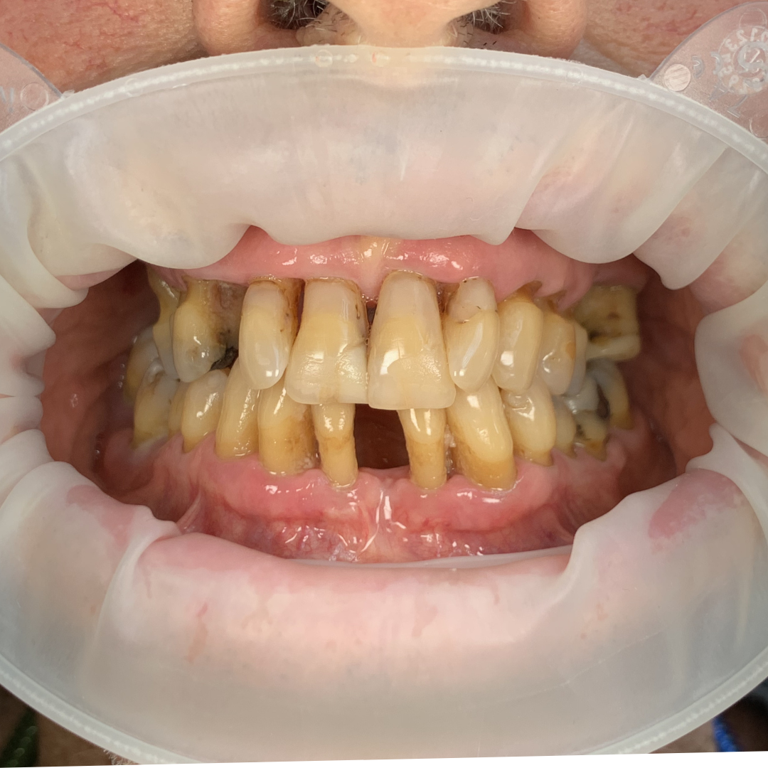 Before and after All-on-X dental implant full mouth rehabilitation at Fidelity Dental Bali