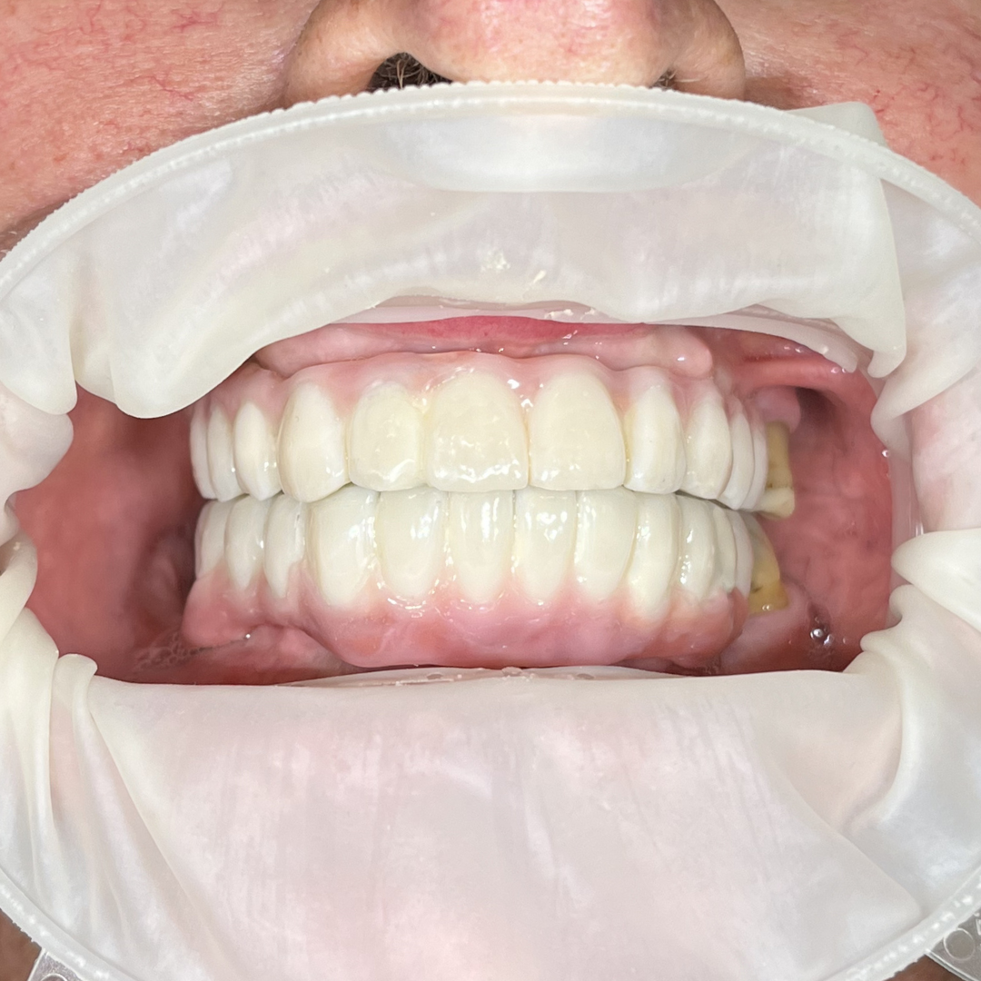 Before and after All-on-X dental implant full mouth rehabilitation at Fidelity Dental Bali