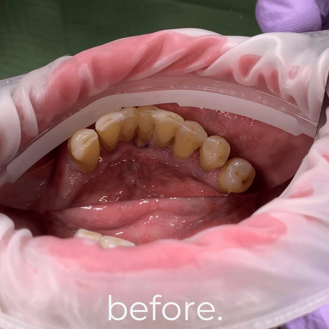 All on X Dental Implants (All on 4, All on 5, All on 6 Full Arch Implants) in Bali - Before 8