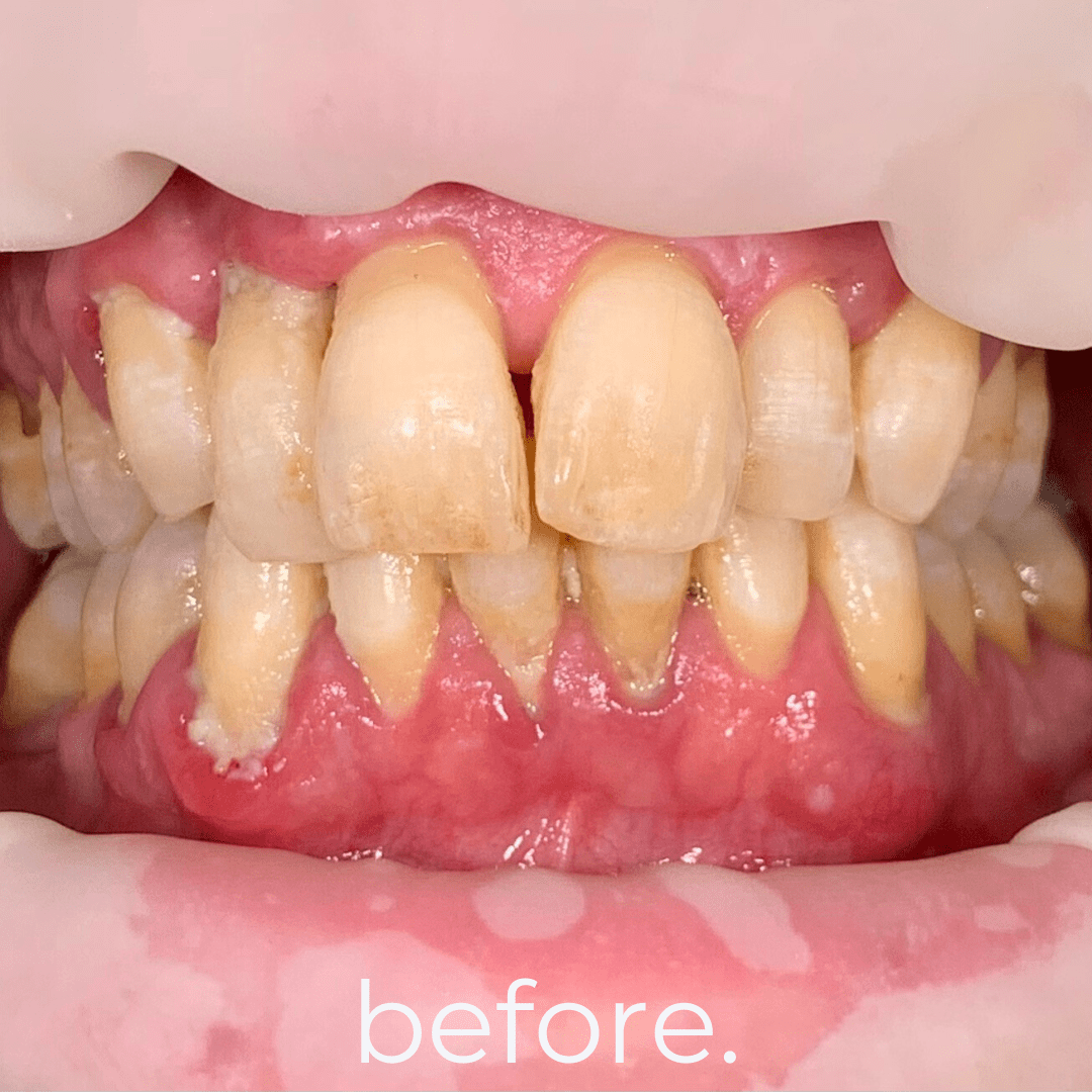 All on X Dental Implants (All on 4, All on 5, All on 6 Full Arch Implants) in Bali - Before 7