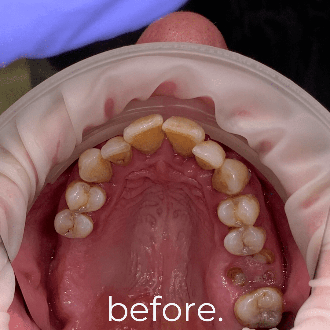 All on X Dental Implants (All on 4, All on 5, All on 6 Full Arch Implants) in Bali - Before 9