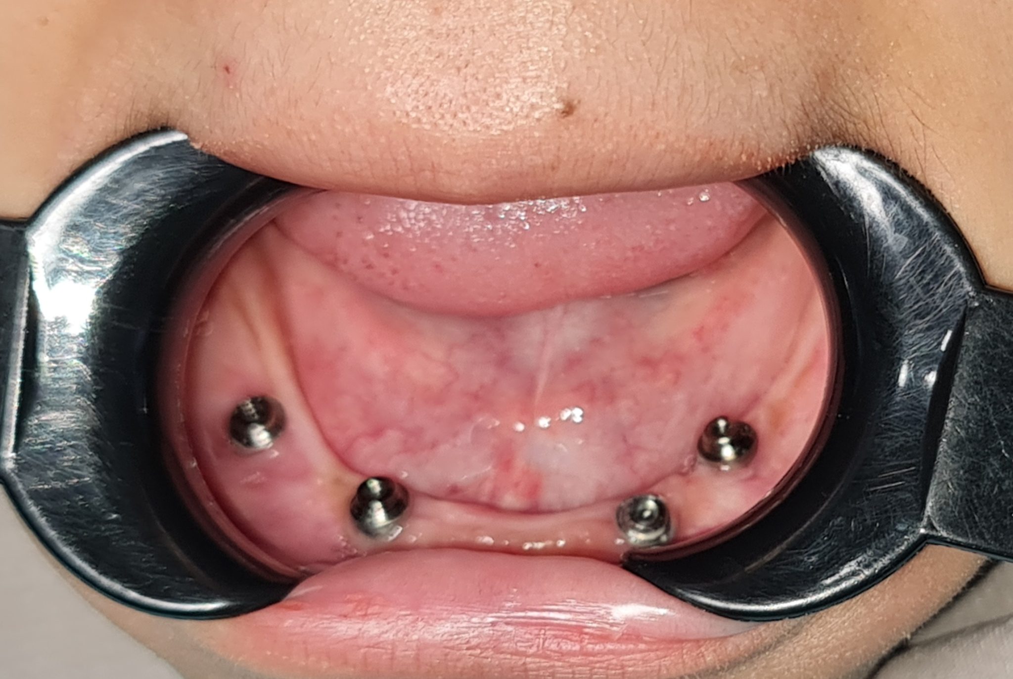 All on X Dental Implants (All on 4, All on 5, All on 6 Full Arch Implants) in Bali - Before 5