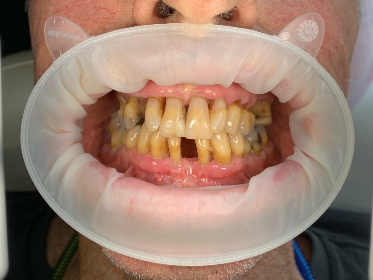 All on X Dental Implants (All on 4, All on 5, All on 6 Full Arch Implants) in Bali - Before 6